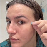 Person applying Acne Rescue Patch to their face in a bathroom setting