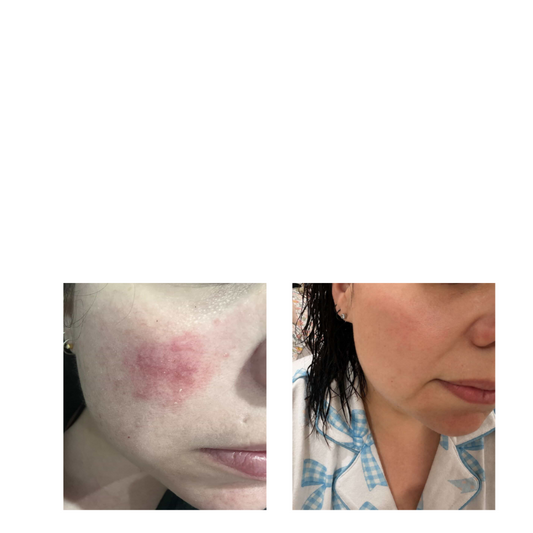 Before and after comparison of a person's face with visible skin condition.